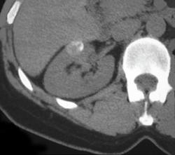 Dense Renal Cyst - CTisus CT Scan