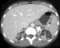 Bilateral Angiomyolipomas - CTisus CT Scan