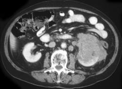 Renal Lymphoma - CTisus CT Scan