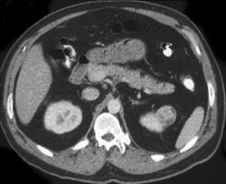 Incidental Renal Cell Cancer - CTisus CT Scan