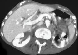 Pyelonephritis With Air in Collecting System - CTisus CT Scan