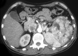 Renal Cell Carcinoma Extends Into Renal Vein and IVC - CTisus CT Scan