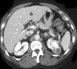 Renal Cell Carcinoma - CTisus CT Scan