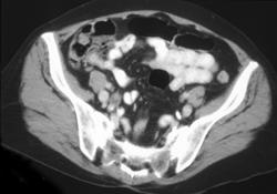 Transitional Cell Carcinoma of the Right Ureter - CTisus CT Scan