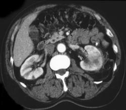 Acute Pyelonephritis - CTisus CT Scan