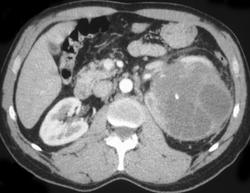 Cystic Renal Cell Carcinoma - CTisus CT Scan