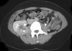 Acute Pyelonephritis - CTisus CT Scan