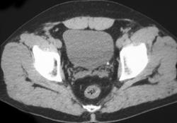 Stone in Distal Ureter - CTisus CT Scan