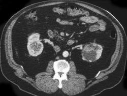 Transitional Cell Carcinoma - CTisus CT Scan