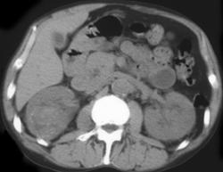 Hypervascular Renal Carcinoma (right) - CTisus CT Scan