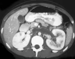 Renal Vein Thrombosis - CTisus CT Scan