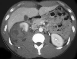 Renal Laceration With Delayed Scans - CTisus CT Scan