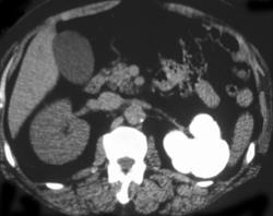 Renal Tuberculosis (TB) - CTisus CT Scan