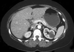 Renal Cyst - CTisus CT Scan