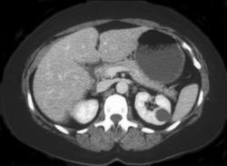 Renal Cyst - CTisus CT Scan