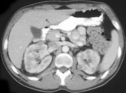 Renal Cell Carcinoma (bilateral) - CTisus CT Scan