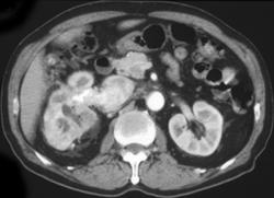 Renal Cell Carcinoma Invades Inferior Vena Cava (IVC) - CTisus CT Scan