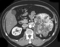 Vascular Renal Cell Carcinoma - CTisus CT Scan