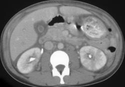 Acute Pyelonephritis - CTisus CT Scan