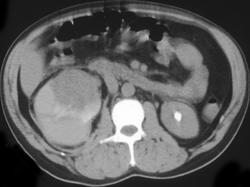 Spontaneous Bleed 2 to Underlying Renal Cell Carcinoma - CTisus CT Scan