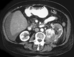 Hypervascular Renal Cell Carcinoma - CTisus CT Scan