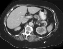 Candidiasis in Left Kidney - CTisus CT Scan