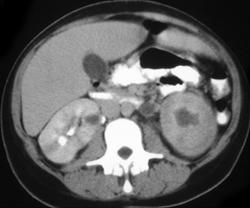 Obstruction 2 to Distal Stone With Pyelonephritis - CTisus CT Scan