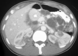 Von Hippel-Lindau syndrome (VHL) With Renal Cysts, Renal Cancers and Metastases to the Pancreas - CTisus CT Scan