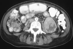 Renal Abscess - CTisus CT Scan