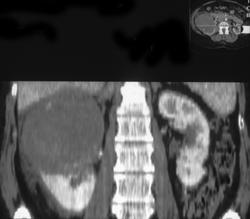 Cystic Renal Cell Carcinoma - CTisus CT Scan