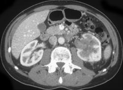 Renal Cell Carcinoma Invades the Inferior Vena Cava (IVC) and Renal Vein - CTisus CT Scan