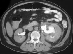 Pyelosinus Extravasation 2 to Stone - CTisus CT Scan