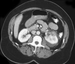 Trauma to Horseshoe Kidney - CTisus CT Scan