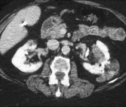 Renal Angiomyolipomas - CTisus CT Scan