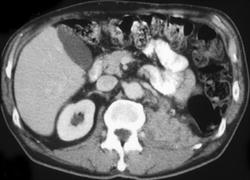 Recurrent Renal Cell Carcinoma in Renal Bed - CTisus CT Scan