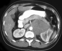 Renal Lymphoma - CTisus CT Scan