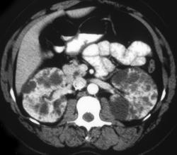 Polycystic Kidneys - CTisus CT Scan