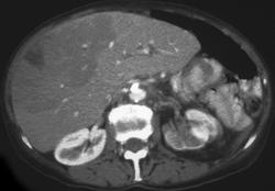 Transitional Cell Cancer of Left Kidney With Liver Metastases - CTisus CT Scan