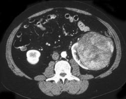 Renal Cell Carcinoma - CTisus CT Scan