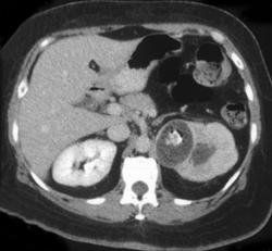 Xanthogranulomatous Pyelonephritis (XGP) - CTisus CT Scan