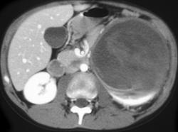 Wilms Tumor - CTisus CT Scan