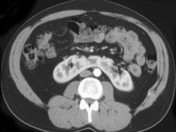 Horseshoe Kidneys - CTisus CT Scan