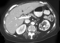 Pyelonephritis With Calculi - CTisus CT Scan