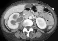 Pyelonephritis Secondary to Obstructing Stone - CTisus CT Scan