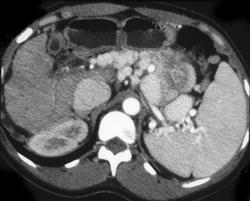 Large Renal Vein Due to Splenorenal Shunt - CTisus CT Scan