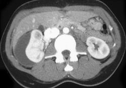 Subcapsular Hematoma - CTisus CT Scan