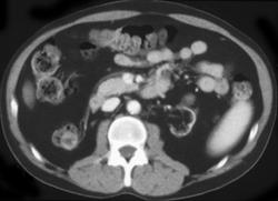 Renal Cell Carcinoma in Dialysis Patient - CTisus CT Scan