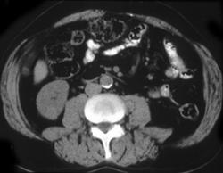 Subtle Renal Cell Carcinoma - CTisus CT Scan