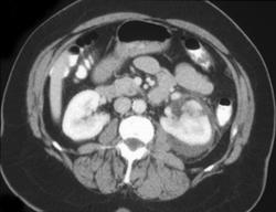 Renal Laceration - CTisus CT Scan