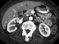 Renal Artery Aneurysm (right) - CTisus CT Scan